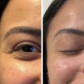 Metox 100 Units photo review