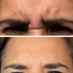 Metox 100 Units photo review