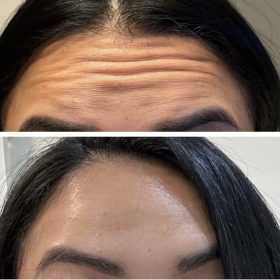 Metox 100 Units photo review