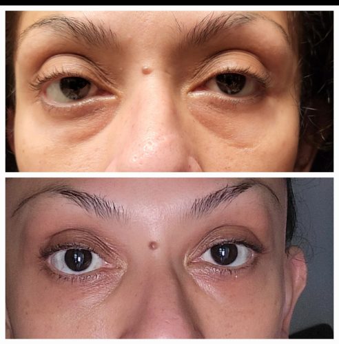 Metox 100 Units photo review