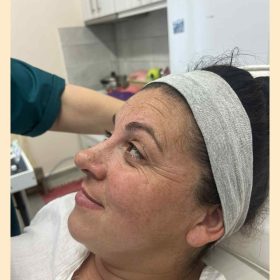 Metox 100 Units photo review