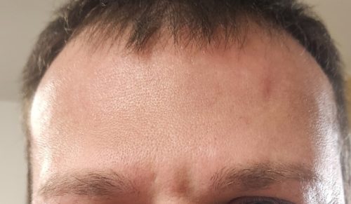 Metox 100 Units photo review