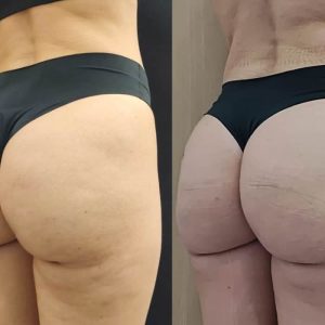 Venufill Body Filler Hard Type photo review