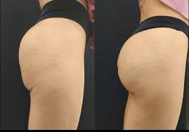 Venufill Body Filler Hard Type photo review