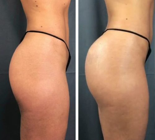 Venufill Body Filler Hard Type photo review