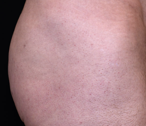 Venufill Body Filler Soft Type photo review