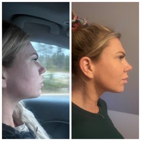 Bienox 100 units photo review