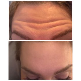 Bienox 100 units photo review