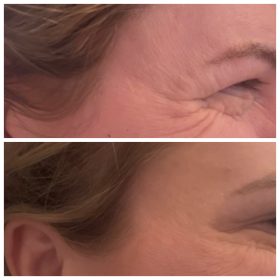 Bienox 100 units photo review