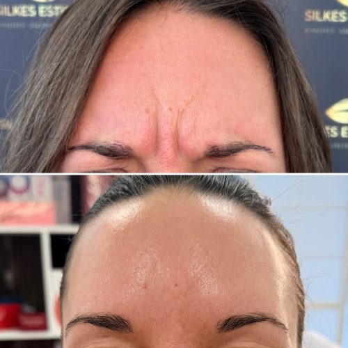 Botulax 300 Units photo review