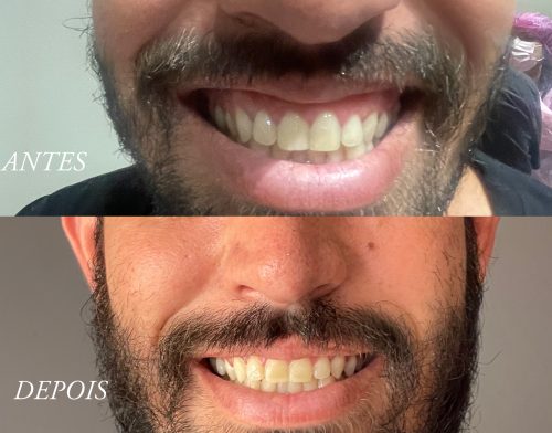 Botulax 300 Units photo review