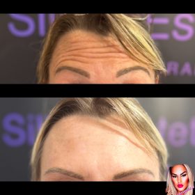 Botulax 300 Units photo review