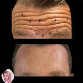 Botulax 300 Units photo review