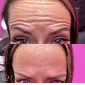 Botulax 300 Units photo review