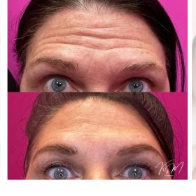 Botulax 300 Units photo review