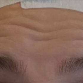 Botulax 300 Units photo review