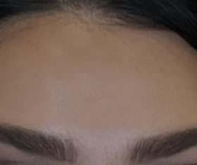 Botulax 300 Units photo review