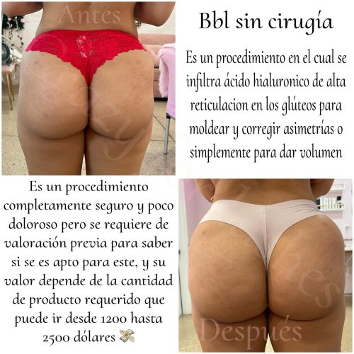 Neo Filler Cannula 17G photo review