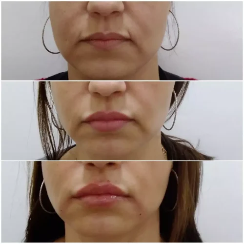 Everline Carving COG PDO 18G x 100mm photo review