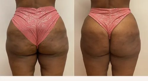 Neo Filler Cannula 17G photo review