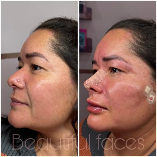 Everline Carving COG PCLA 18G x 100mm photo review