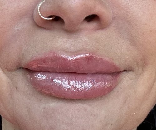 Elasty D Plus (2 syringes) photo review