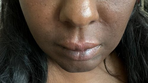 Elasty G plus (2 syringes) photo review