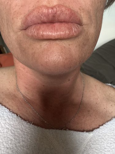 Elasty D Plus (2 syringes) photo review