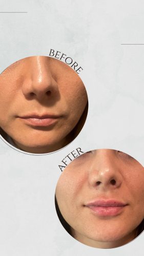 Click to view full screen Tesoro DEEP with Lidocaine photo review