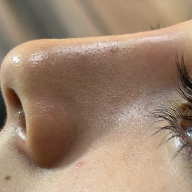 Tesoro IMPLANT with Lidocaine photo review