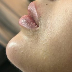 Tesoro IMPLANT with Lidocaine photo review