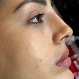 Tesoro IMPLANT with Lidocaine photo review