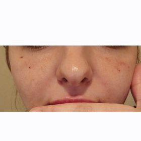 HyalDew Shine no Lidocaine photo review