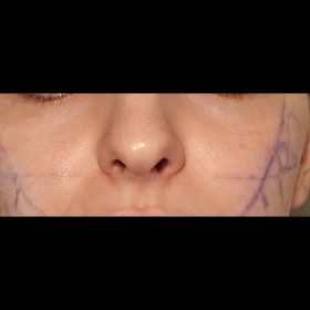 HyalDew Shine no Lidocaine photo review