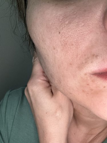 Lidocaine 2% Huons photo review