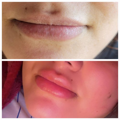 Elasty D Plus (1 syringe) photo review