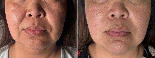 Elasty G Plus (1 syringe) photo review