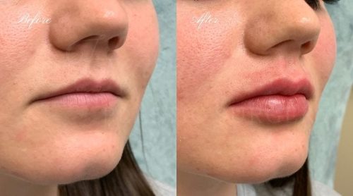 Elasty G Plus (1 syringe) photo review