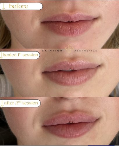 Elasty D Plus (1 syringe) photo review