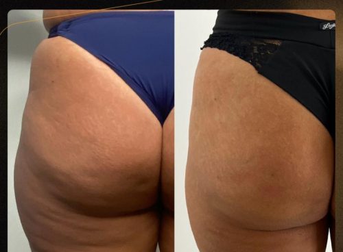 Maxy Fill Body Filler 70 ml photo review